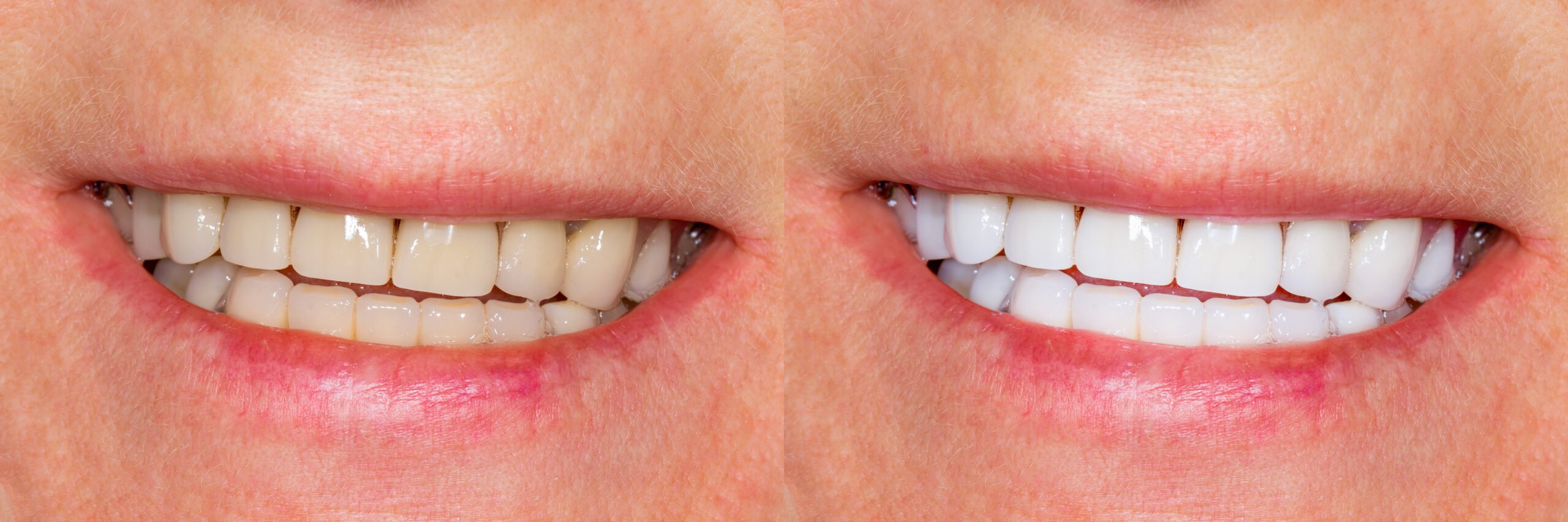 Dental veneers, ceramic crowns before and after treatment. Close-up of teeth and smile of person.